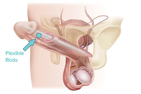 penile prosthesis