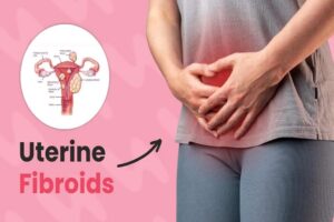 Navigating the Challenges of Uterine Fibroids: A Guide to Understanding and Managing Your Health